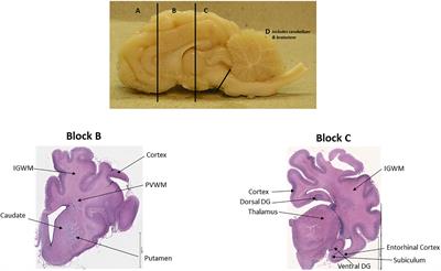 Dysmaturation of Somatostatin Interneurons Following Umbilical Cord Occlusion in Preterm Fetal Sheep